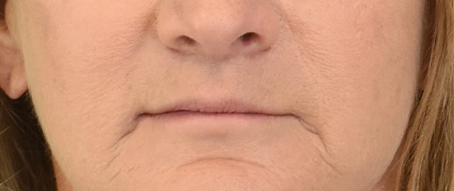 Lip Lift Patient 16 Set 1 After
