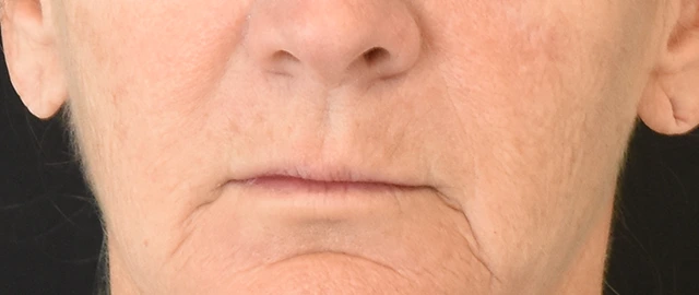 Lip Lift Patient 16 Set 1 Before