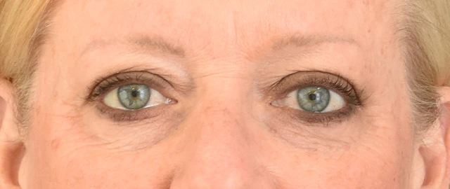 Brow Lift Patient 16 Set 1 Before