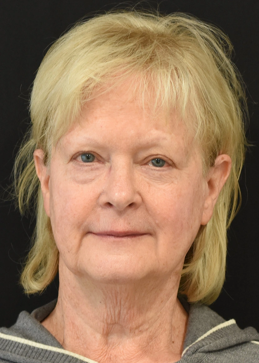 Deep Plane Facelift Patient 38 Set 1 Before